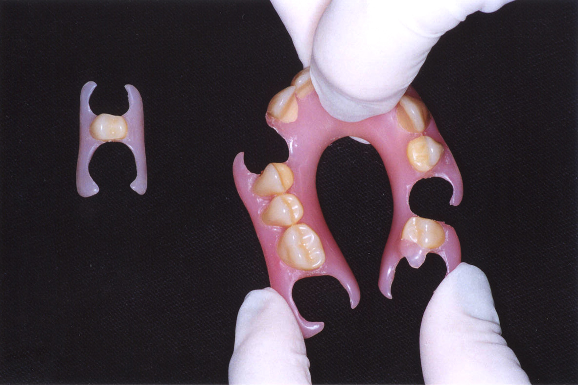 Foto Prótese Flexível Unilateral e&nbsp;Bilateral