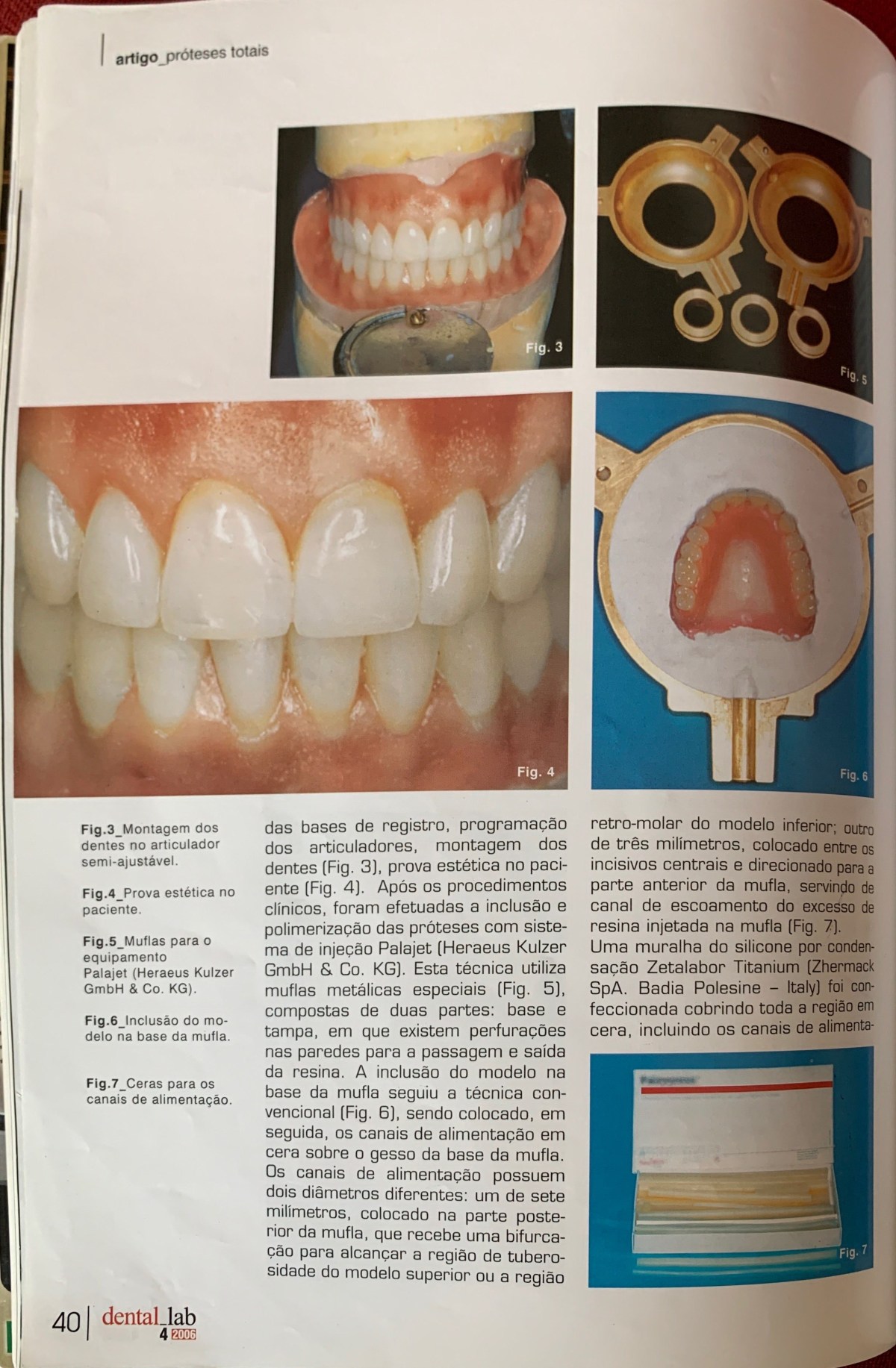 Sistema de Injeção no Processamento de Próteses Totais _relato de um caso&nbsp;clinico